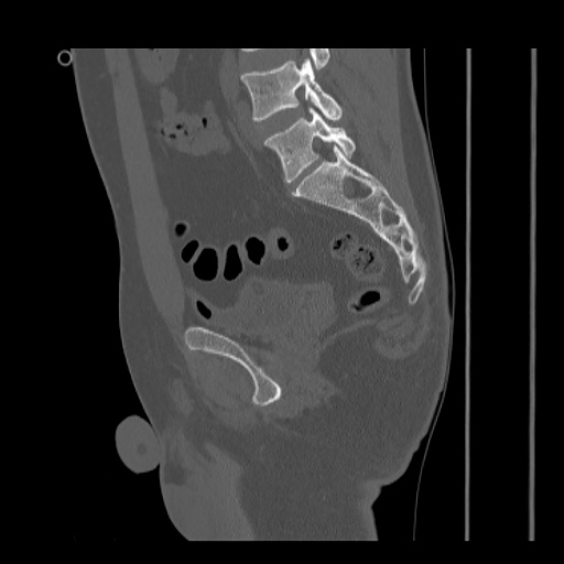 File:Acetabular and ilial fractures (Radiopaedia 59084-66378 Sagittal bone window 57).jpg
