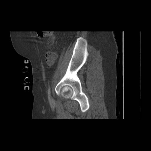 File:Acetabular fracture (Radiopaedia 13193-13212 Sagittal bone window 25).jpg