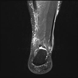 File:Achilles tendon tear (Radiopaedia 77615-89819 Coronal STIR 22).jpg