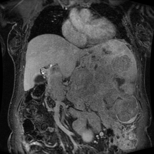File:Acinar cell carcinoma of the pancreas (Radiopaedia 75442-86668 Coronal T1 C+ fat sat 119).jpg