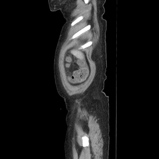 Acinar cell carcinoma of the pancreas (Radiopaedia 75442-86669 Sagittal C+ portal venous phase 29).jpg