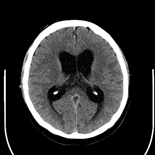 File:Acoustic schwannoma (Radiopaedia 39170-41389 Axial non-contrast 16).png