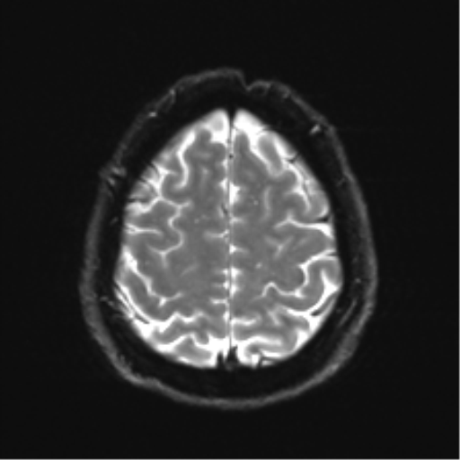 Acoustic schwannoma (Radiopaedia 50846-56358 Axial DWI 25).png
