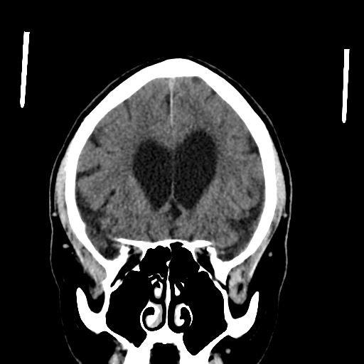 File:Acoustic schwannoma (Radiopaedia 55729-62280 Coronal non-contrast 15).png