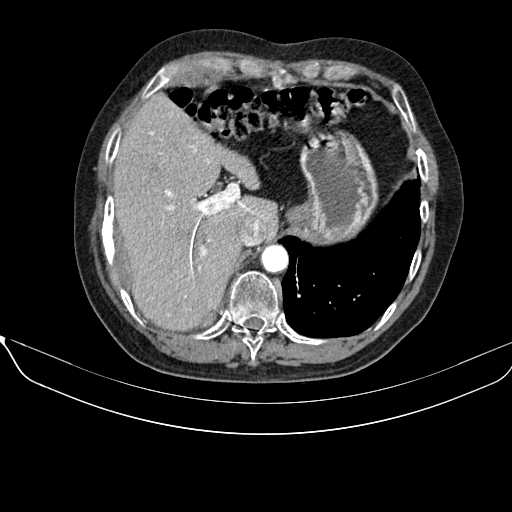 File:Acquired adrenal hyperplasia - due to thymic carcinoid tumor (Radiopaedia 21269-21184 C+ arterial phase 12).jpg