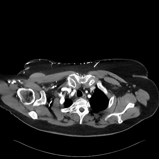 Acromioclavicular joint cyst (Radiopaedia 58455-65610 Axial C+ arterial phase 26).jpg