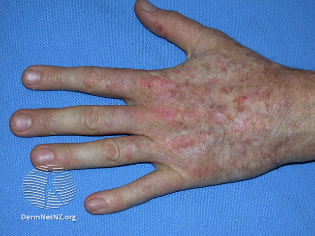 File:Actinic keratoses affecting the hands (DermNet NZ lesions-ak-hands-411).jpg