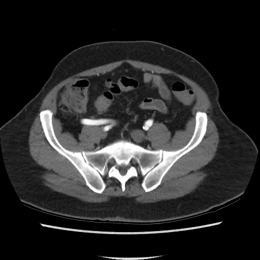 Active colonic bleed on CT (Radiopaedia 49765-55025 Axial C+ arterial phase 61).jpg