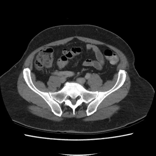 File:Active colonic bleed on CT (Radiopaedia 49765-55025 Axial C+ delayed 60).jpg