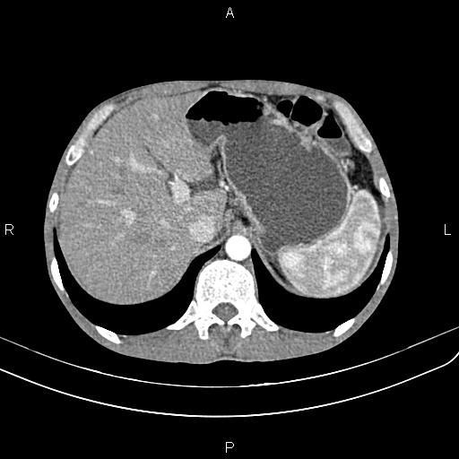 Active crohn disease (Radiopaedia 87133-103397 Axial C+ arterial phase 24).jpg