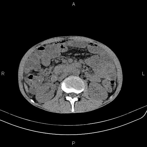File:Active crohn disease (Radiopaedia 87133-103397 Axial non-contrast 44).jpg