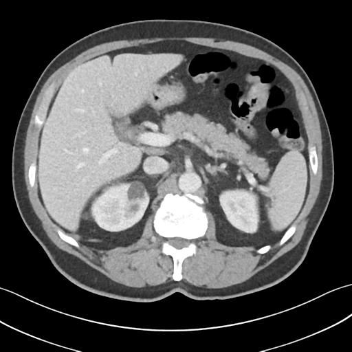 File:Active diverticular hemorrhage (Radiopaedia 39415-41725 Axial C+ portal venous phase 19).png