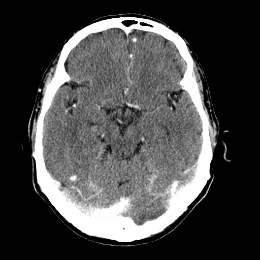 File:Active neurocysticercosis before and after therapy (Radiopaedia 71710-82099 Axial C+ delayed 65).jpg