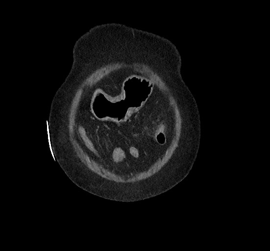 Active renal extravasation with large subcapsular and retroperitoneal hemorrhage (Radiopaedia 60975-68796 Coronal C+ portal venous phase 24).jpg