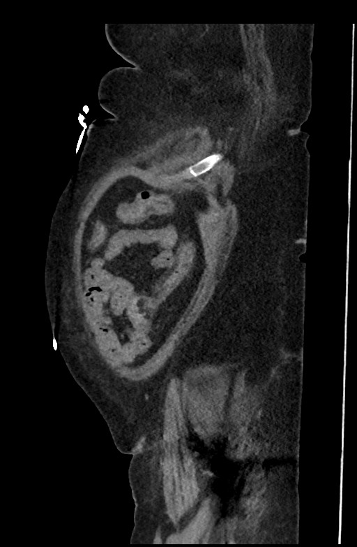 Active renal extravasation with large subcapsular and retroperitoneal hemorrhage (Radiopaedia 60975-68796 Sagittal C+ portal venous phase 191).jpg