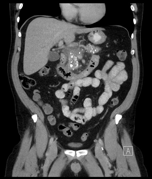Acute-on-chronic pancreatitis (Radiopaedia 67286-76656 Coronal C+ portal venous phase 36).jpg
