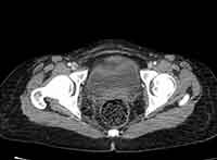 Acute Budd-Chiari syndrome (Radiopaedia 60858-68638 A 286).jpg