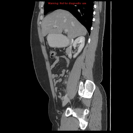 File:Acute appendicitis (Radiopaedia 10498-10973 Sagittal C+ portal venous phase 12).jpg