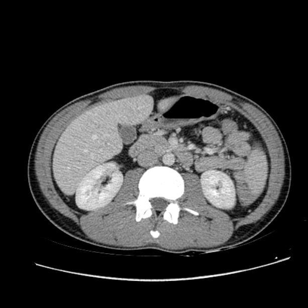 Acute appendicitis (Radiopaedia 27049-27227 Axial C+ portal venous phase 30).jpg