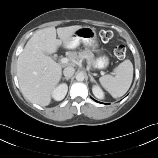 File:Acute appendicitis (Radiopaedia 30297-30934 Axial C+ portal venous phase 21).jpg
