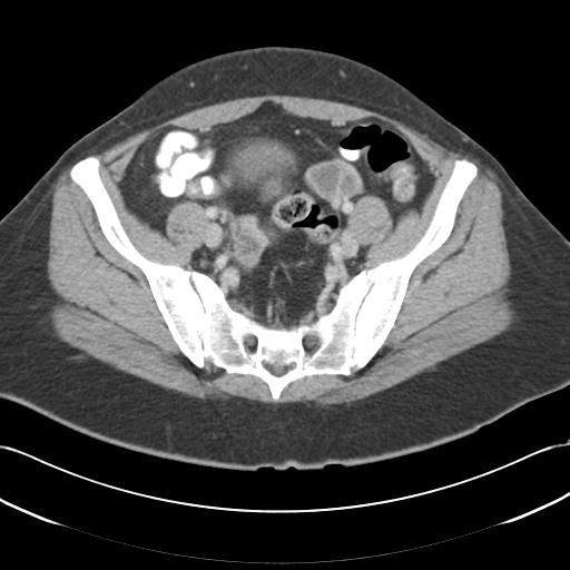 File:Acute appendicitis (Radiopaedia 30297-30934 Axial C+ portal venous phase 64).jpg