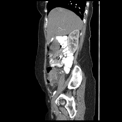 File:Acute appendicitis (Radiopaedia 52672-58589 Sagittal C+ arterial phase 32).jpg