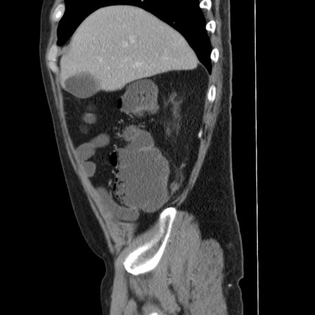 Acute appendicitis (Radiopaedia 66513-75790 Sagittal C+ portal venous phase 28).jpg