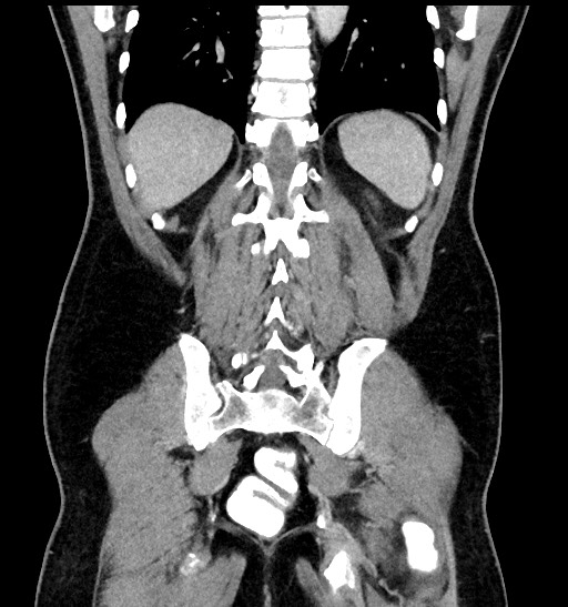 Acute appendicitis (Radiopaedia 77016-88960 Coronal C+ portal venous phase 76).jpg