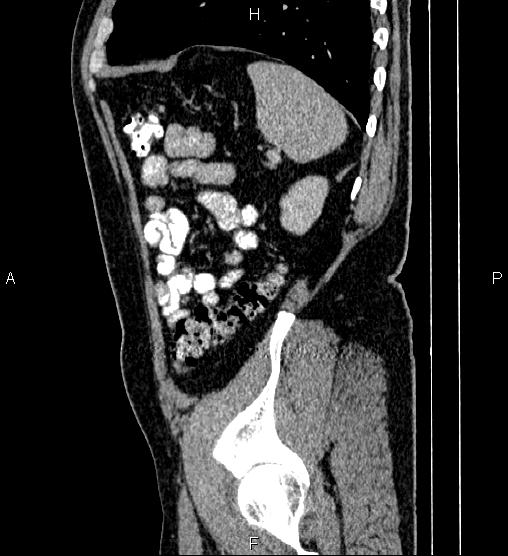 Acute appendicitis (Radiopaedia 84780-100240 Sagittal C+ portal venous phase 86).jpg