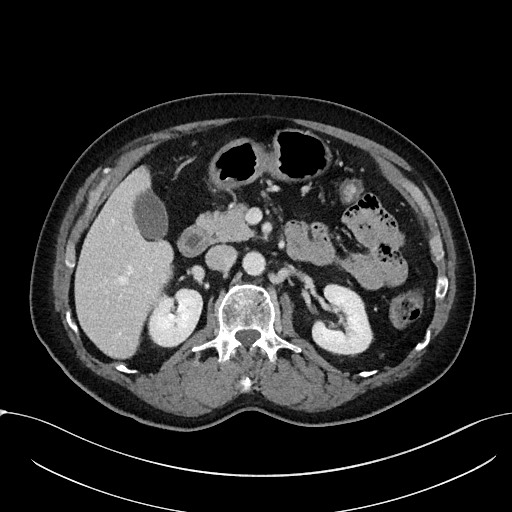 Acute appendicitis - large appendicoliths (Radiopaedia 61805-69820 Axial C+ portal venous phase 46).jpg