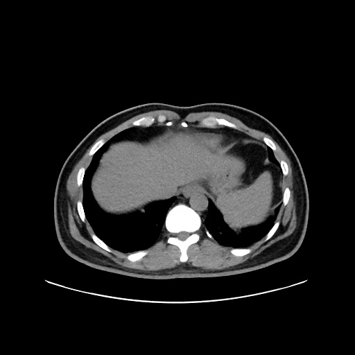 Acute appendicitis and COVID 19 pneumonia (Radiopaedia 76604-88380 Axial non-contrast 47).jpg