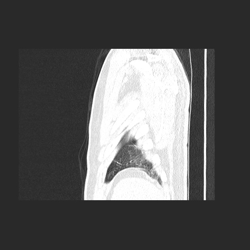 File:Acute appendicitis and COVID 19 pneumonia (Radiopaedia 76604-88380 Sagittal lung window 87).jpg
