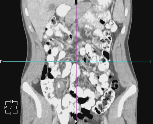 File:Acute appendicitis with CT arrowhead sign (Radiopaedia 21474-21411 Coronal C+ portal venous phase 5).JPG