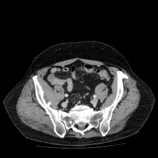 Acute cholecystitis and incidental left sided IVC (Radiopaedia 49352-54459 Axial C+ portal venous phase 119).jpg