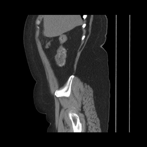 File:Acute cholecystitis with tensile fundus sign (Radiopaedia 71394-81723 Sagittal non-contrast 47).jpg