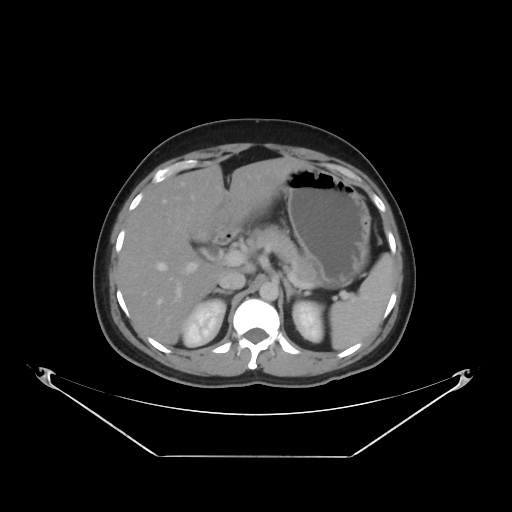 File:Acute complicated calculous cholecystitis (Radiopaedia 55202-61587 Axial C+ delayed 32).jpg