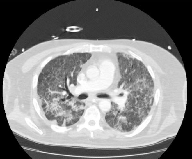 Acute cor pulmonale (ultrasound) (Radiopaedia 83508-98818 Axial lung window 40).jpg