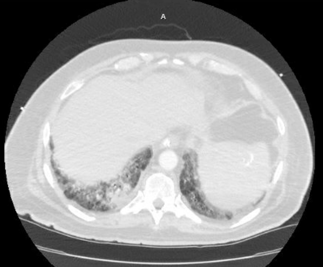 Acute cor pulmonale (ultrasound) (Radiopaedia 83508-98818 Axial lung window 74).jpg