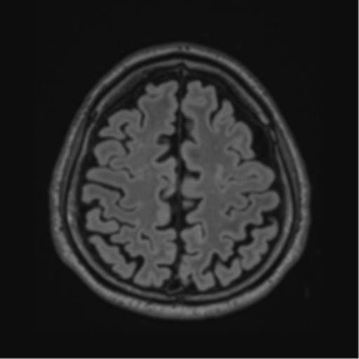 Acute disseminated encephalomyelitis (ADEM)- Anti-NMDA receptor encephalitis (Radiopaedia 54920-61201 Axial FLAIR 54).png
