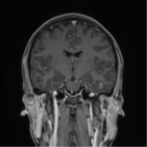 File:Acute disseminated encephalomyelitis (ADEM) (Radiopaedia 65319-74349 Coronal T1 C+ 26).png