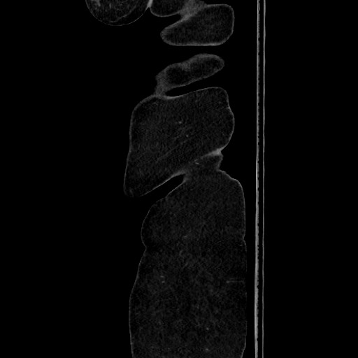 Acute diverticulitis - transverse colon (Radiopaedia 87063-103327 Sagittal C+ portal venous phase 24).jpg
