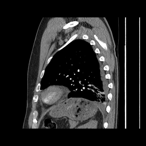 Acute epicardial fat necrosis (Radiopaedia 42327-45440 Sagittal C+ CTPA 54).jpg