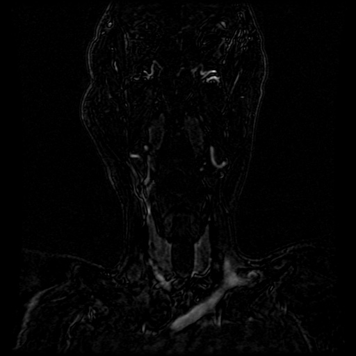 Acute internal carotid artery dissection (Radiopaedia 53541-59632 Coronal MRA 76).jpg