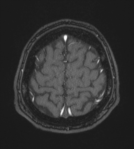 Acute left middle cerebral artery territory infarct with clot retrieval (Radiopaedia 47732-52433 Axial MRA 59).png