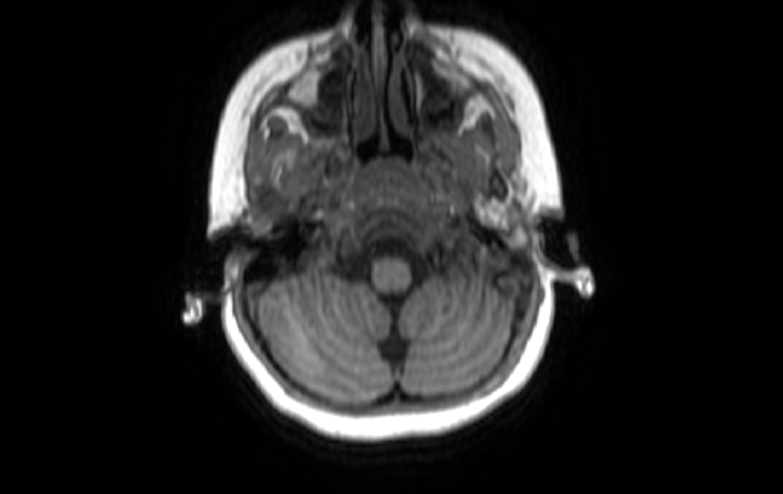 File:Acute necrotizing encephalitis of childhood (Radiopaedia 67356-76737 Axial T1 82).jpg