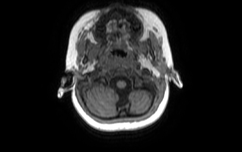 File:Acute necrotizing encephalitis of childhood (Radiopaedia 67356-76737 Axial T1 86).jpg