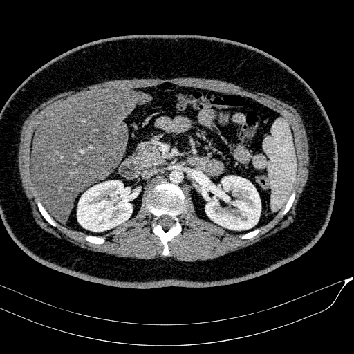 Acute on chronic pancreatitis (Radiopaedia 80902-94423 Axial C+ portal venous phase 69).jpg