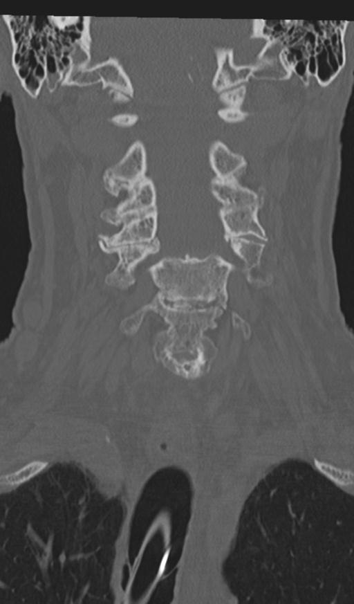 Acute on chronic subdural hematoma and thoracic vertebral injury in a multitrauma patient (Radiopaedia 31698-32619 Coronal bone window 25).jpg