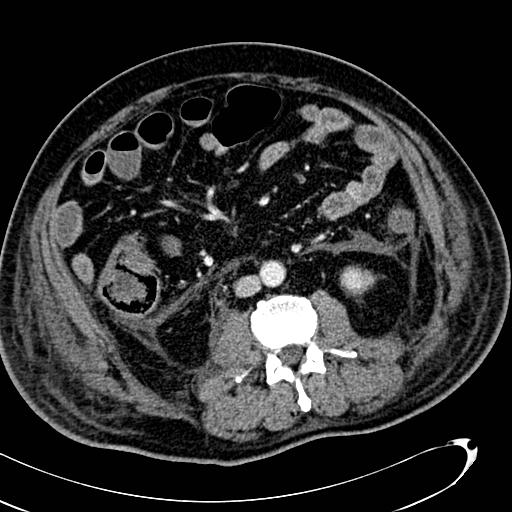 File:Acute pancreatic necrosis (Radiopaedia 13560-13486 Axial C+ portal venous phase 86).jpg