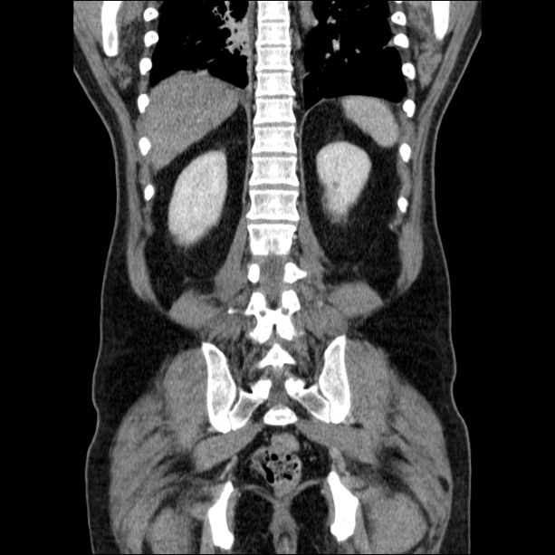 Acute pancreatitis (Radiopaedia 26663-26813 Coronal C+ portal venous phase 49).jpg